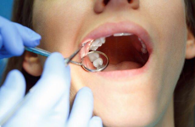 نیوزیلند استفاده از آمالگام در دندان بچه ها را ممنوع نمود